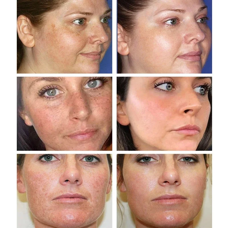 Effective Whitening Freckles C - огляд і ціна Licorice Root Sticks